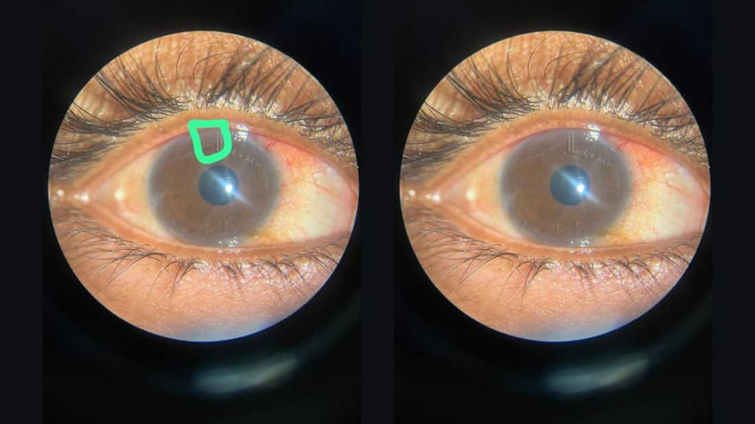 46-Year-Old Sharjah Resident with Uncontrolled Glaucoma Successfully Treated with Microshunt Surgery at Aster Hospital